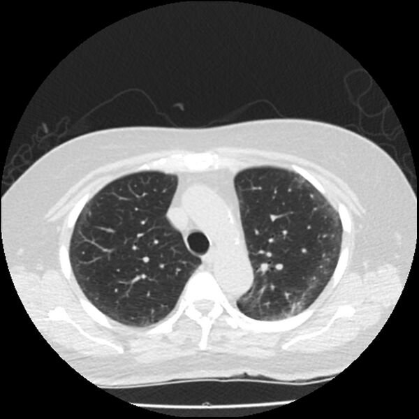 File:Acute interstitial pneumonitis (Radiopaedia 45404-49444 Axial lung window 32).jpg