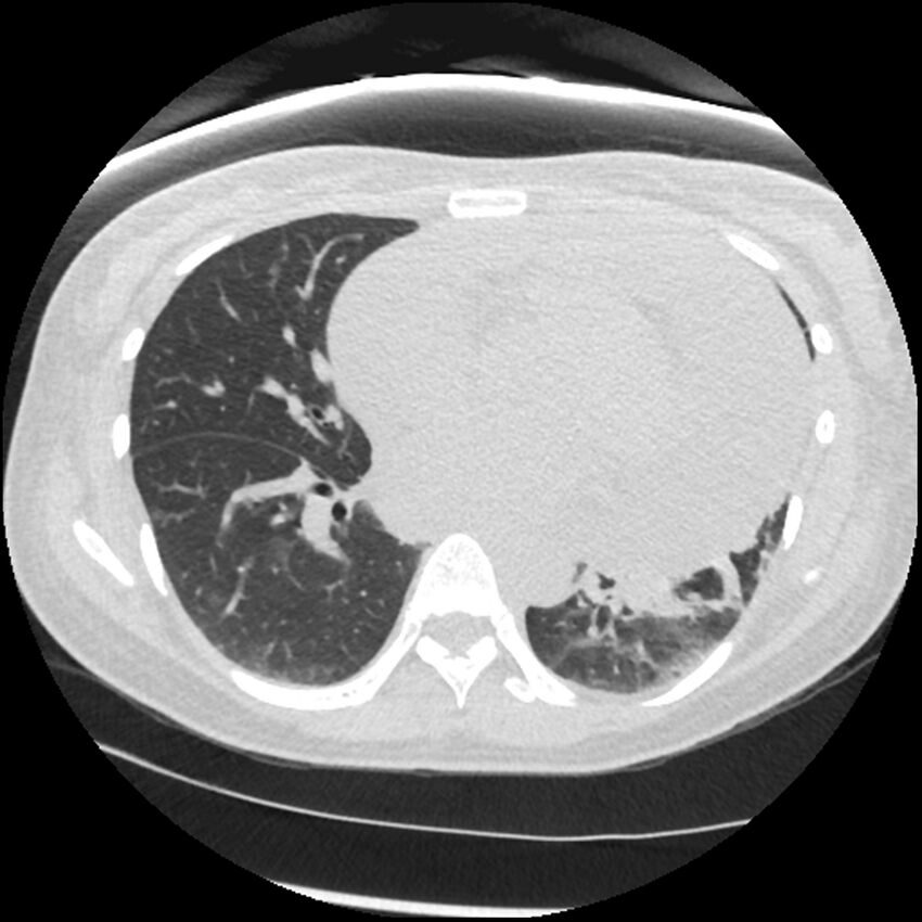 Acute lupus nephritis (Radiopaedia 45832-50107 Axial lung window 54).jpg