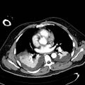 Acute pancreatic necrosis (Radiopaedia 13560-13486 Axial C+ portal venous phase 3).jpg