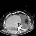 Acute pancreatic necrosis (Radiopaedia 13560-18501 Axial C+ portal venous phase 11).jpg