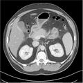 Acute pancreatitis - mild (Radiopaedia 27796-28033 C+ portal venous phase 11).jpg