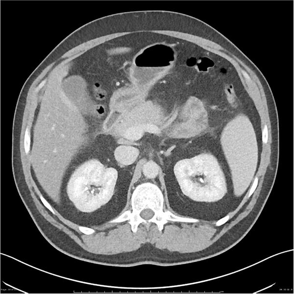 File:Acute pancreatitis - mild (Radiopaedia 27796-28033 C+ portal venous phase 11).jpg