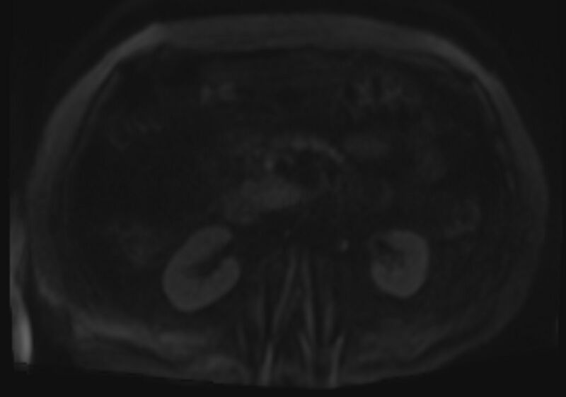 File:Acute portal vein thrombosis (Radiopaedia 73198-83925 Axial DWI 81).jpg