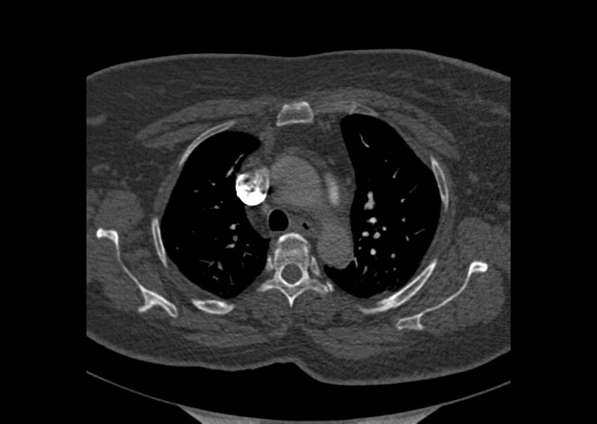 Acute pulmonary embolism (Radiopaedia 29938-30466 Axial C+ CTPA 6).jpg