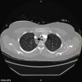 Acute reversible pulmonary hypertension and right heart failure from cocaine toxicity (Radiopaedia 49394-54517 Axial C+ CTPA 1).jpg