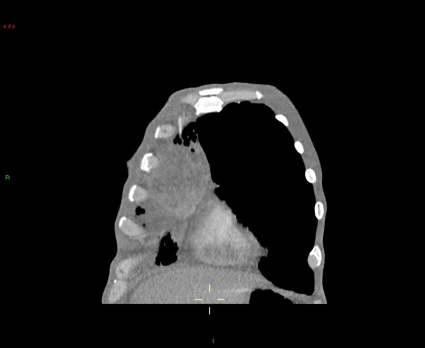 Acute right lung abscess (Radiopaedia 34806-36258 Coronal C+ arterial phase 50).jpg