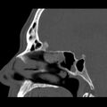 Acute sinusitis (Radiopaedia 23161-23215 Sagittal bone window 32).jpg