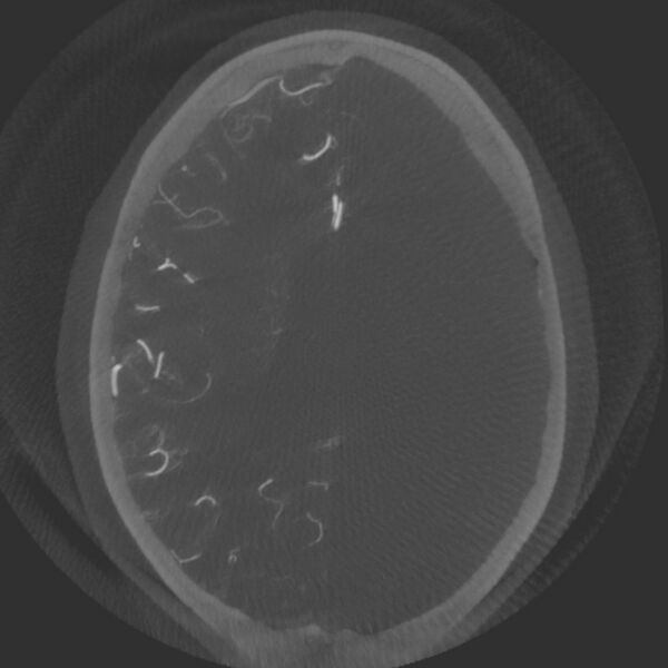 File:Acute subarachnoid hemorrhage and accessory anterior cerebral artery (Radiopaedia 69231-79010 Axial arterial - MIP 53).jpg