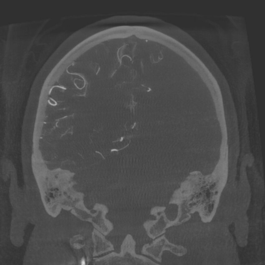 Acute subarachnoid hemorrhage and accessory anterior cerebral artery (Radiopaedia 69231-79010 Coronal arterial - MIP 70).jpg