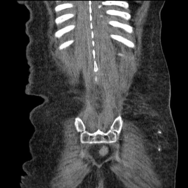 File:Acute tubular necrosis (Radiopaedia 28077-28334 D 73).jpg