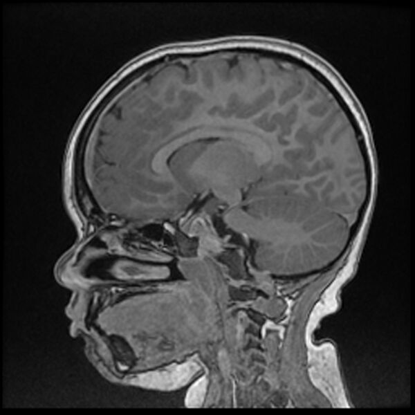 File:Adamantinomatous craniopharyngioma (Radiopaedia 77407-89529 Sagittal T1 C+ 58).jpg