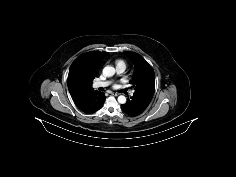 File:Adenocarcinoma of pancreas with hepatic metastasis (Radiopaedia 64332-73122 Axial C+ portal venous phase 2).jpg