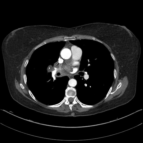 File:Adenocarcinoma of the lung (Radiopaedia 44205-47803 Axial C+ portal venous phase 43).jpg