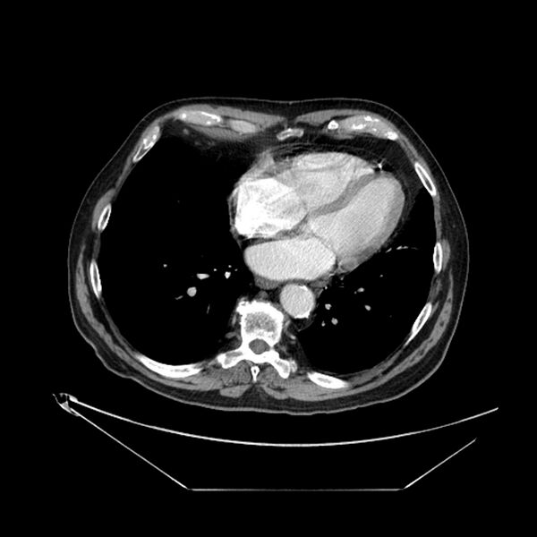 File:Adenocarcinoma of the lung (Radiopaedia 44876-48759 Axial C+ portal venous phase 58).jpg