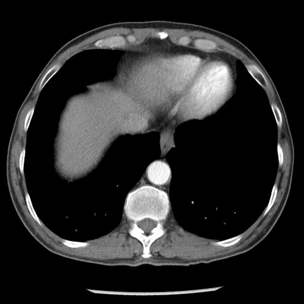 File:Adenocarcinoma of the lung - micropapillary predominant (Radiopaedia 42446-45563 Axial C+ portal venous phase 60).jpg