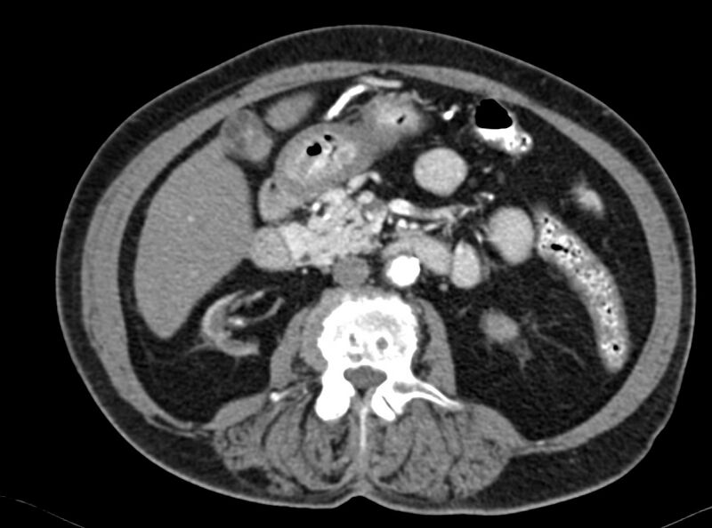 File:Adenomyomatosis of the gallbladder (Radiopaedia 12142-12483 Axial C+ arterial phase 18).jpg