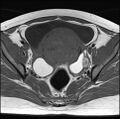 Adenomyosis - ovarian endometriomas (Radiopaedia 67031-76350 Axial T1 14).jpg