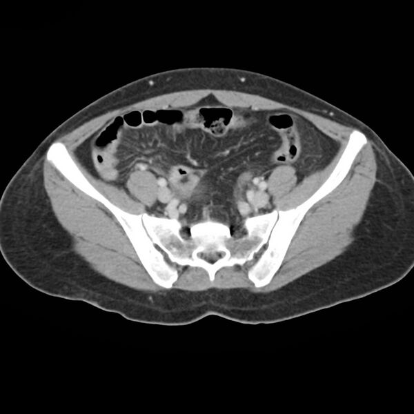 File:Adenomyosis of the uterus (Radiopaedia 9868).jpg