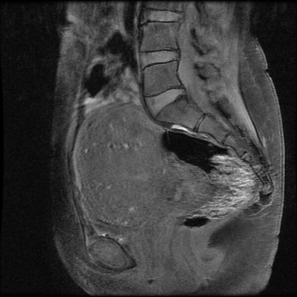 File:Adenomyosis on MRI (Radiopaedia 29328-29780 Sagittal T1 fat sat 9).jpg