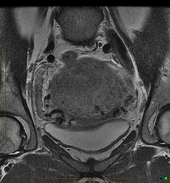 File:Adenomyosis uterus with hematometra (Radiopaedia 45779-50011 Coronal T2 7).jpg