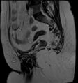 Adnexal multilocular cyst (O-RADS US 3- O-RADS MRI 3) (Radiopaedia 87426-103754 Sagittal T2 8).jpg