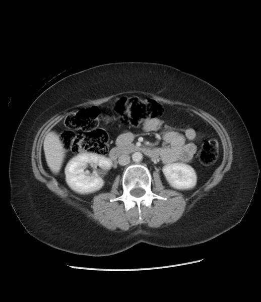 File:Adrenal cortical carcinoma with IVC invasion and thrombosis (Radiopaedia 34307-35597 Axial C+ portal venous phase 41).jpg