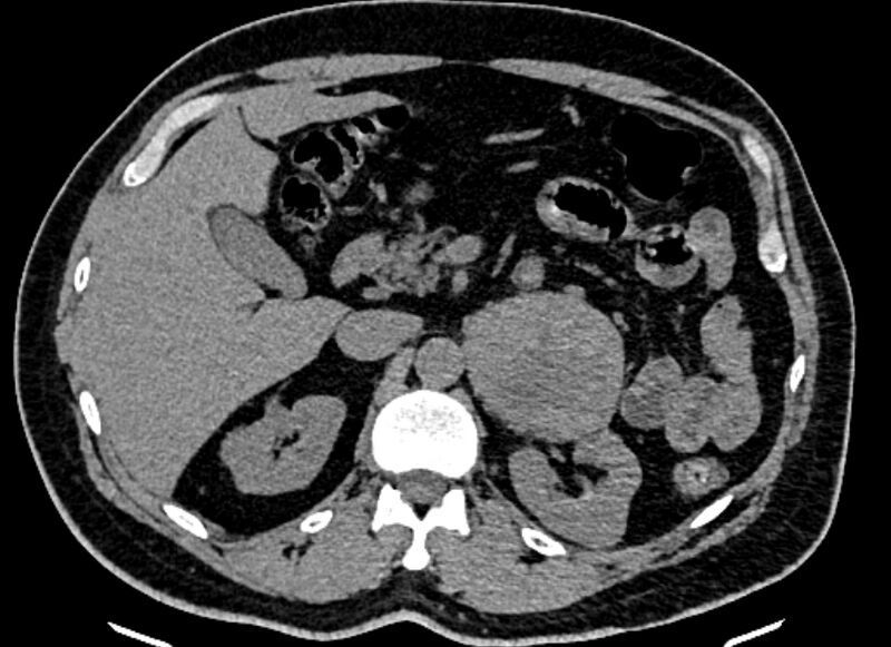 File:Adrenal metastases (Radiopaedia 73082-83791 Axial non-contrast 60).jpg