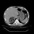 Adrenal myelolipoma (Radiopaedia 41843-44834 Axial non-contrast 9).jpg
