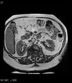 Adrenal myelolipoma (Radiopaedia 6765-7961 Axial T1 out-of-phase 27).jpg