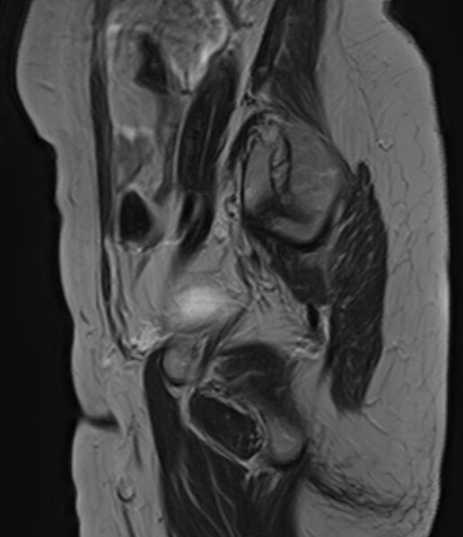 File:Adult granulosa cell tumor of the ovary (Radiopaedia 71581-81950 Sagittal T2 4).jpg