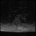 Aggressive vertebral hemangioma (Radiopaedia 39937-42404 Axial T1 C+ fat sat 24).png