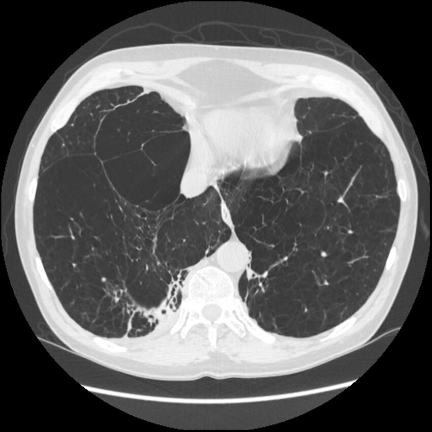 Alpha-1-antitrypsin deficiency (Radiopaedia 40993-43722 Axial lung window 192).jpg