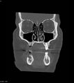 Ameloblastoma (Radiopaedia 18115-17901 Axial bone window 23).jpg