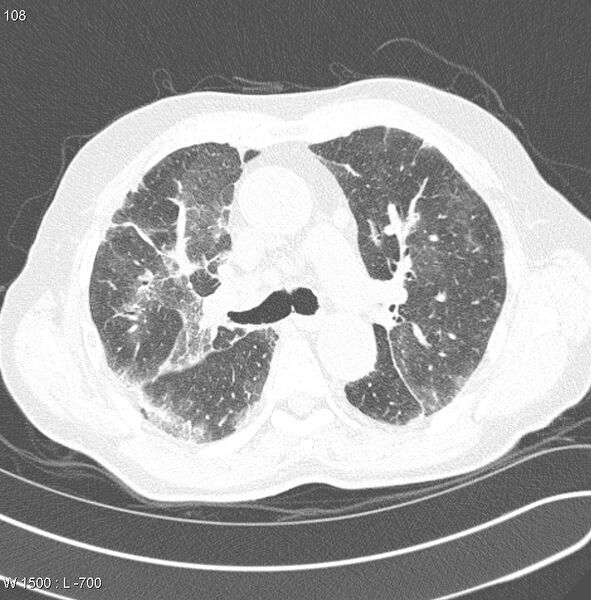 File:Amiodarone lung (Radiopaedia 6539-7851 Axial lung window 11).jpg