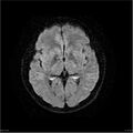 Amnestic syndrome secondary to hypoxic brain injury (Radiopaedia 24743-25004 DWI 16).jpg