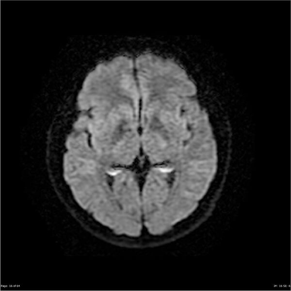 File:Amnestic syndrome secondary to hypoxic brain injury (Radiopaedia 24743-25004 DWI 16).jpg