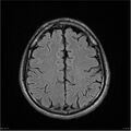 Amnestic syndrome secondary to hypoxic brain injury (Radiopaedia 24743-25004 FLAIR 16).jpg