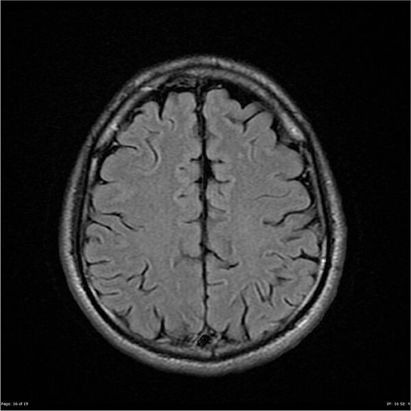 File:Amnestic syndrome secondary to hypoxic brain injury (Radiopaedia 24743-25004 FLAIR 16).jpg
