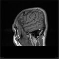 Amnestic syndrome secondary to hypoxic brain injury (Radiopaedia 24743-25004 T1 1).jpg