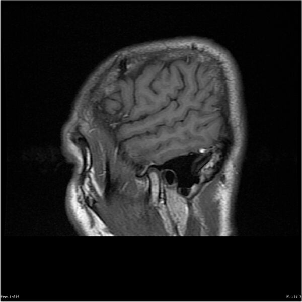File:Amnestic syndrome secondary to hypoxic brain injury (Radiopaedia 24743-25004 T1 1).jpg