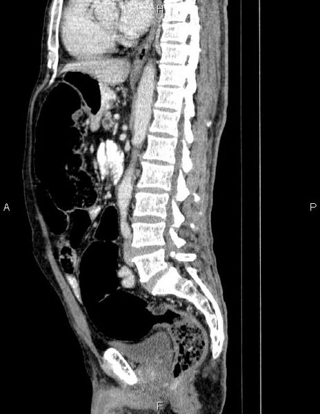 File:Ampullary adenocarcinoma (Radiopaedia 86093-102032 D 52).jpg