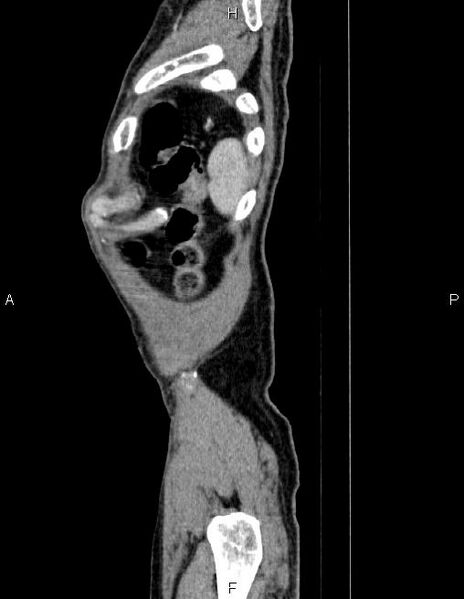 File:Ampullary adenocarcinoma (Radiopaedia 86093-102032 D 94).jpg