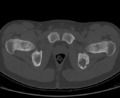 Aneurysmal bone cyst of ischium (Radiopaedia 25957-26094 Axial bone window 66).png