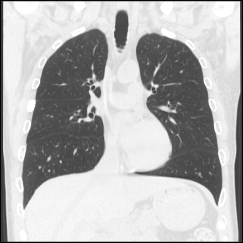 Angioinvasive aspergillosis (Radiopaedia 43957-47466 Coronal lung window 54).jpg