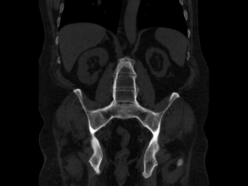 Ankylosing spondylitis (Radiopaedia 44609-48357 Coronal bone window 54).jpg
