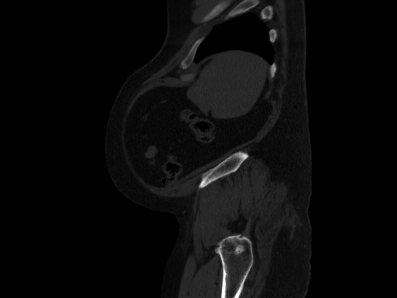 File:Ankylosing spondylitis (Radiopaedia 44609-48357 Sagittal bone window 102).jpg