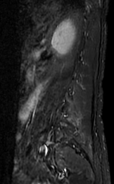 File:Ankylosing spondylitis - Andersson lesion (Radiopaedia 81878-95838 Sagittal STIR 12).jpg