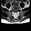 Ankylosing spondylitis with zygapophyseal arthritis (Radiopaedia 38433-40517 C 4).jpg