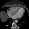 Anomalous origin of left circumflex artery from right coronary sinus (Radiopaedia 72563-83117 B 108).jpg