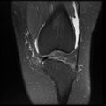 Anterior cruciate ligament tear, Wrisberg rip and bucket-handle tear of medial meniscus (Radiopaedia 75872-87266 Coronal PD fat sat 10).jpg
